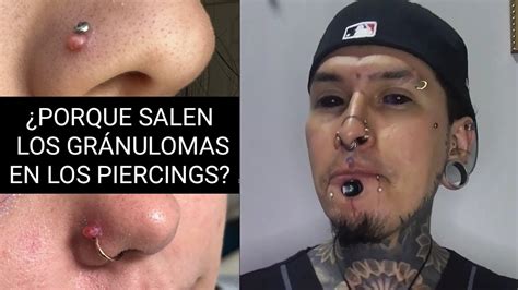 granuloma piercing-4